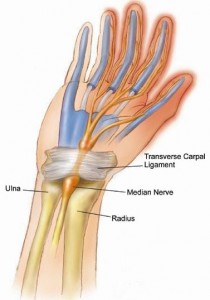 carpal tunnel syndrome